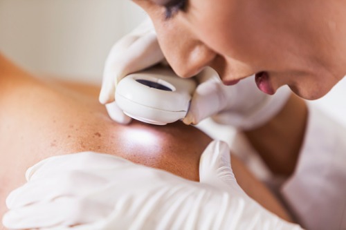 Canada among nations most vulnerable to skin cancer