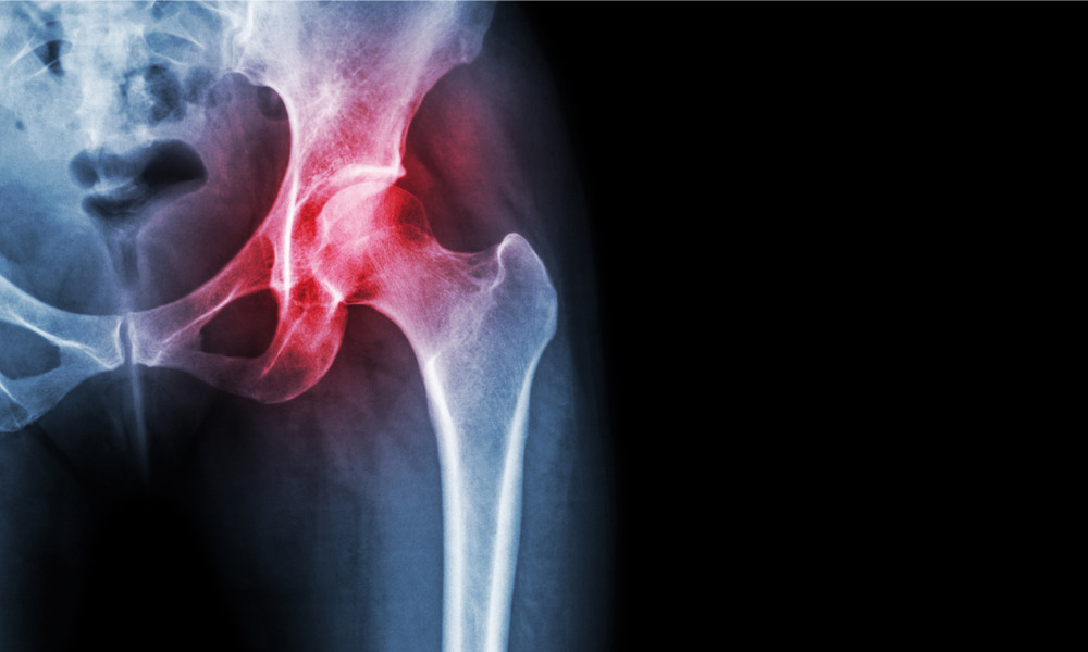 New Brunswick reduces number of people waiting for hip, knee surgery