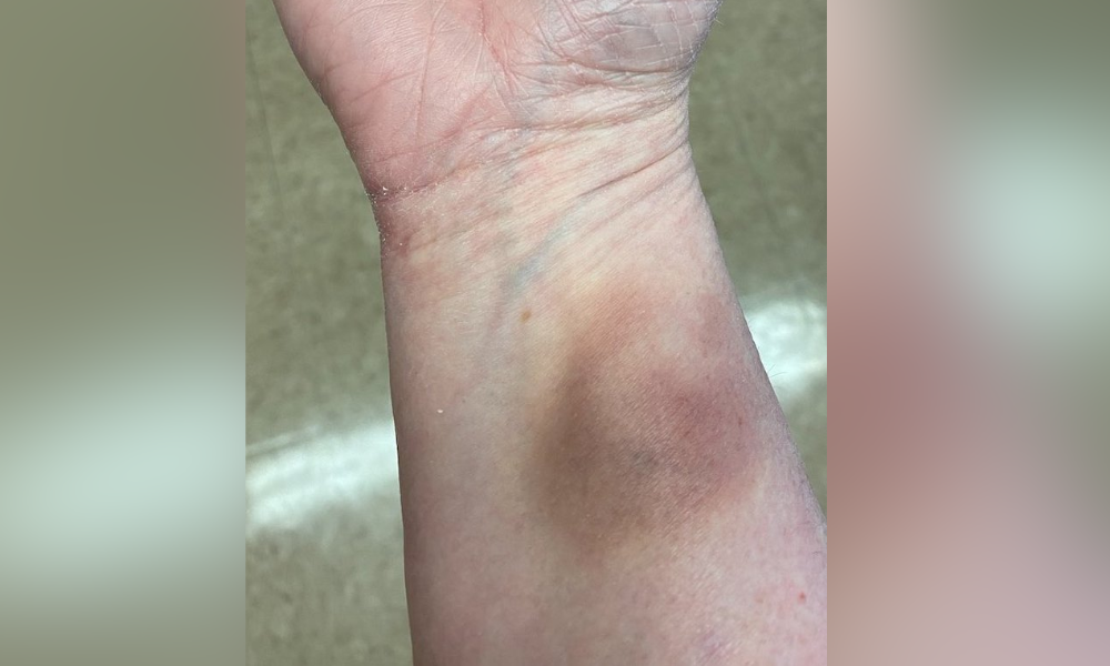 Bite bruise on teacher ‘not shocking’ amid rising school violence