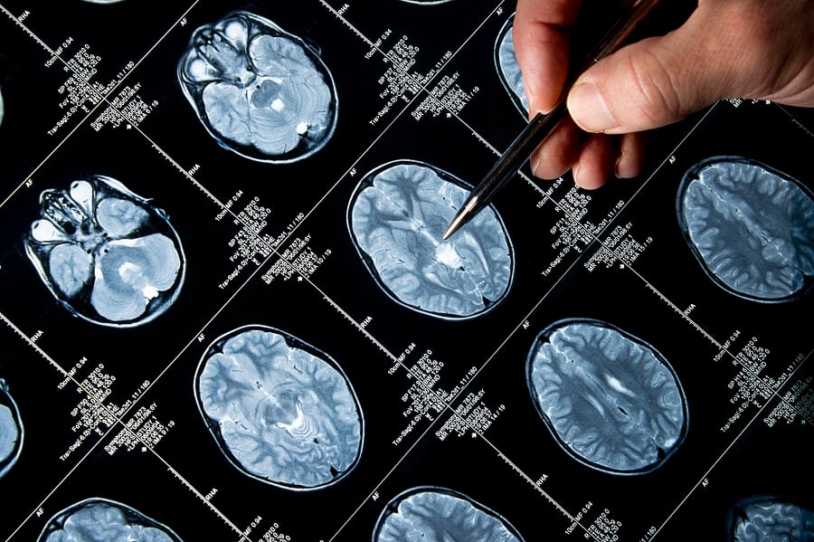 Oscars shine light on Alzheimer's costs