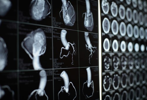 Cigna joins cause to save more Kiwi lives