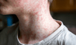 How plan sponsors can deal with measles in the workplace 
