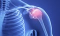 Aviva defeats bid to escape Minor Injury Guideline over psychotherapist diagnosis