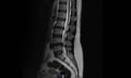Definity secures MIG hold after claimant fails all psychological validity tests