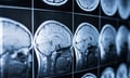 Ex-AFL player challenges league over concussion compensation