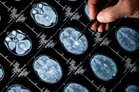 Oscars shine light on Alzheimer's costs
