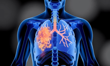 Managing silicosis risk