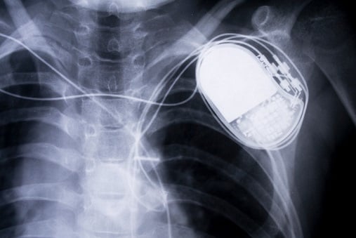 Far Out Friday: Pacemaker data foils fraudulent claim