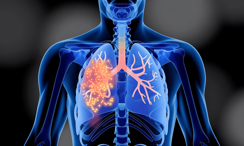 Managing silicosis risk